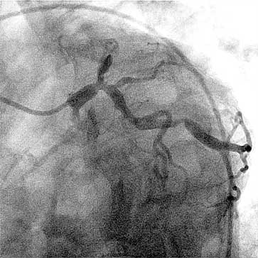 Kenneth's angiogram