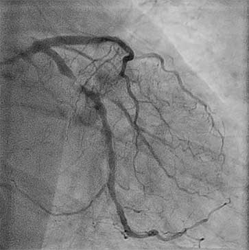 Rafael's angiogram