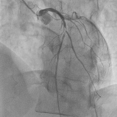 Emergent case–absorption issues: Angiogram of proximal LAD occlusion at the origin of the first diagonal branch