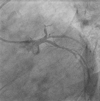 STEMI: Angiograms of thrombotic total occlusion of the mid LAD and evidence of fresh thrombus