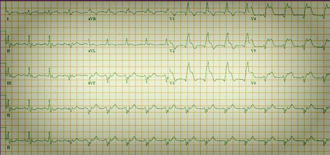 ECG: image with 5 mm of ST elevation in anterior leads