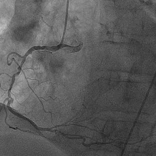 NSTEMI: Angiograms of 80% occlusion of the proximal LAD, bifurcated lesion involving the circumflex artery, and evidence of calcification
