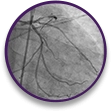 cp-accordion-image-2_stemi Vessel structure in STEMI case profile