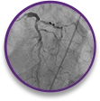 cp-accordion-image-3_nstemi Vessel structure in NSTEMI case profile