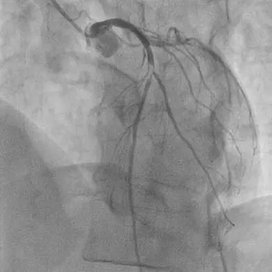 Emergent-(LAD) Image of proximal left descending artery occlusion at the origin of the first diagonal branch