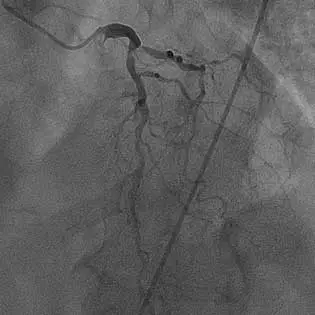 NSTEMI-A-(LAD) Image of 80% occlusion of the proximal LAD with evidence of calcification within an NSTEMI patient