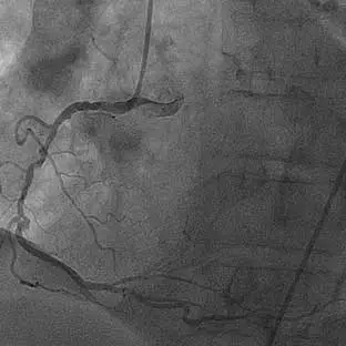 NSTEMI-B-(bifurcated) Image of bifurcated lesion involving the circumflex artery with evidence of calcification within an NSTEMI patient