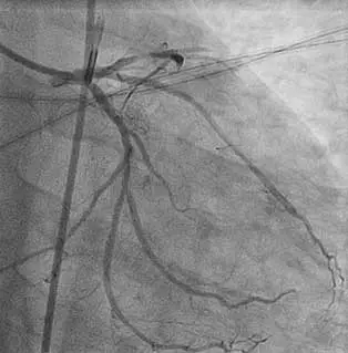 STEMI-(LAD) Image of fresh thrombus within a STEMI patient