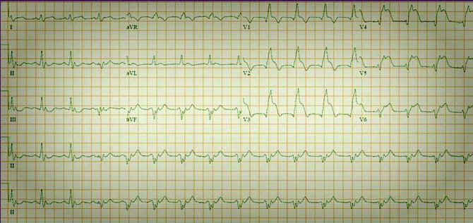pci-2-3 5 mm of ST elevation in anterior leads image